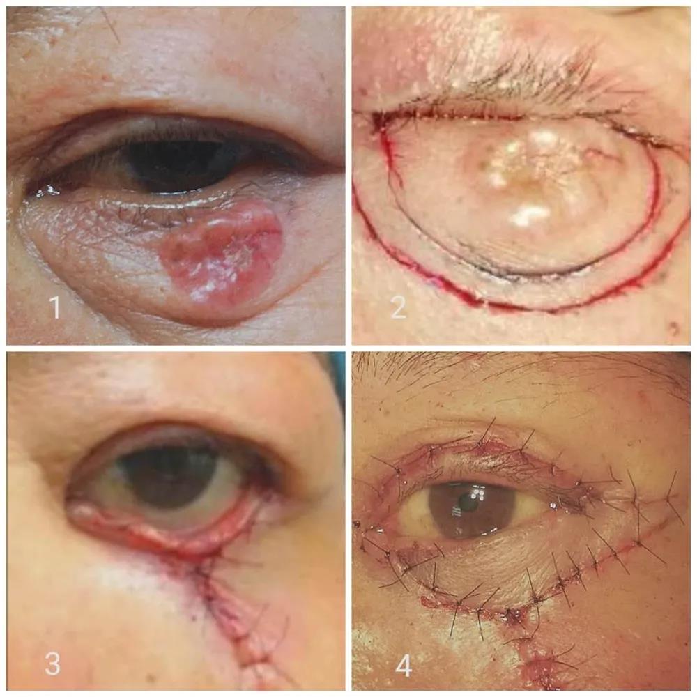 医线前沿〗市医院眼科成功开展眼睑恶性肿瘤切除联合上睑带蒂肌皮瓣